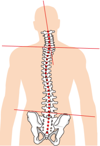 背骨の歪みが